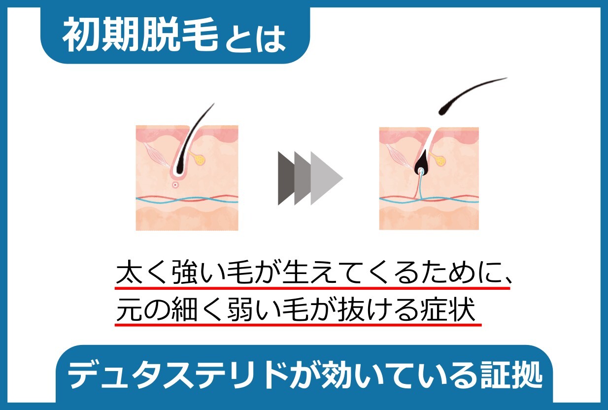 デュタステリドの初期脱毛