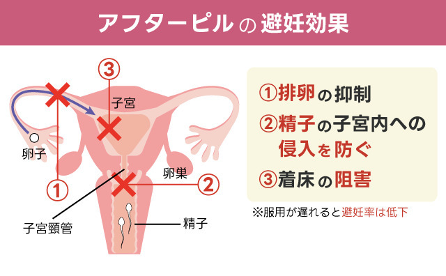 ノルパックの避妊効果